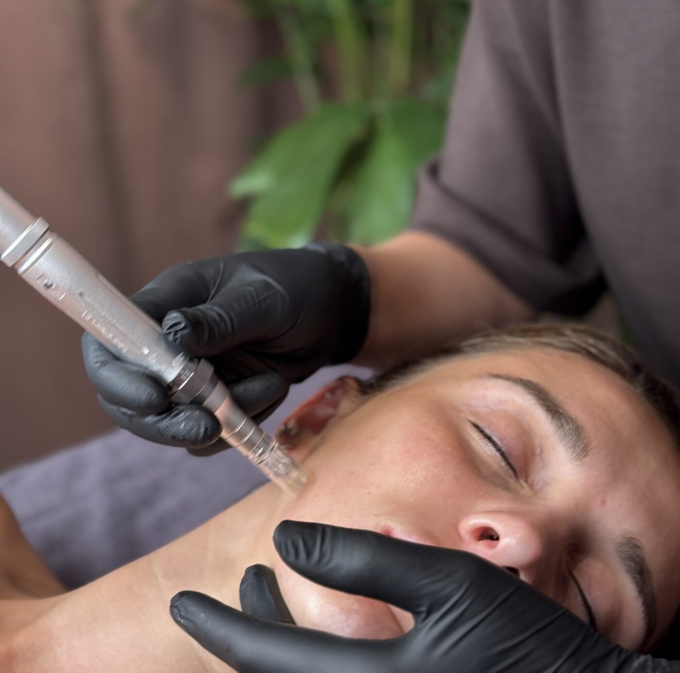 Microneedling